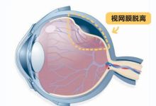 眼睛痛怎么办 眼部撞击后几天视网膜脱落